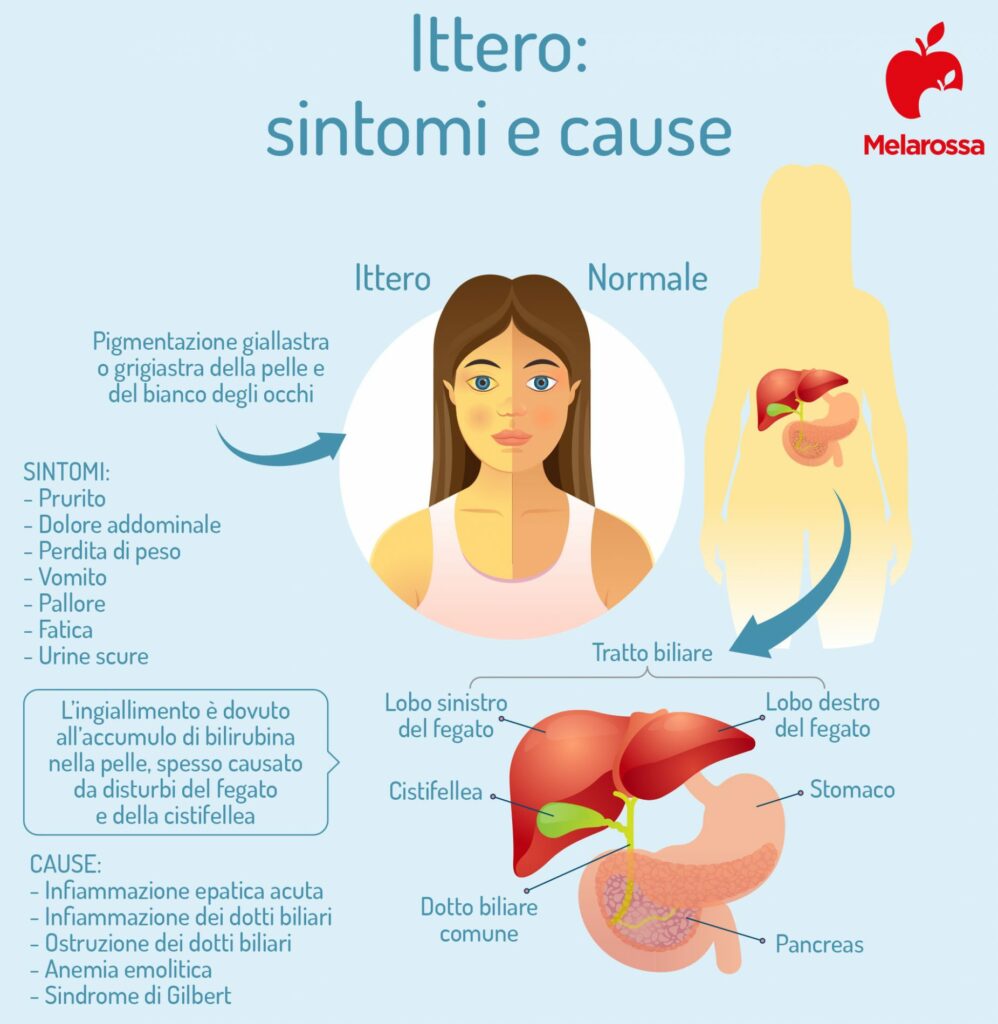 Ittero: Cause, Sintomi e Trattamenti